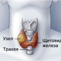 Диффузно-узловой зоб